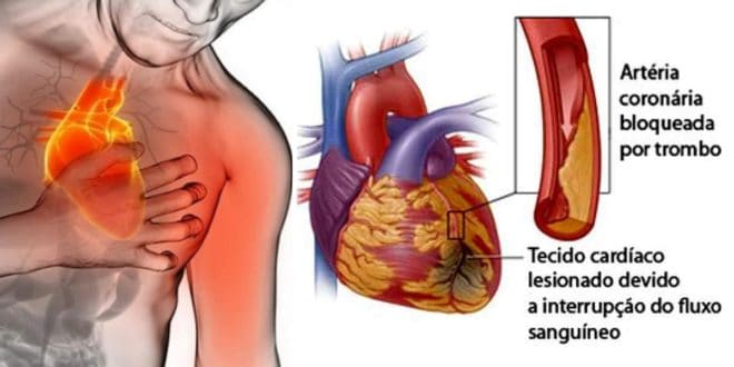 Você sabia que os sintomas de Infarto em Mulheres podem ser diferente?